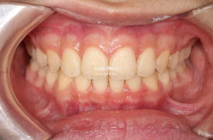 어린이 투명교정 인비절라인 퍼스트 가위교합 돌출교정 덧니교정 관련 이미지 8