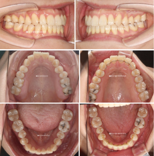 Is Invisalign Treatment Possible After Double-Jaw Surgery? A Real One-Year Case of Surgery-First Orthodontic Treatment image 11