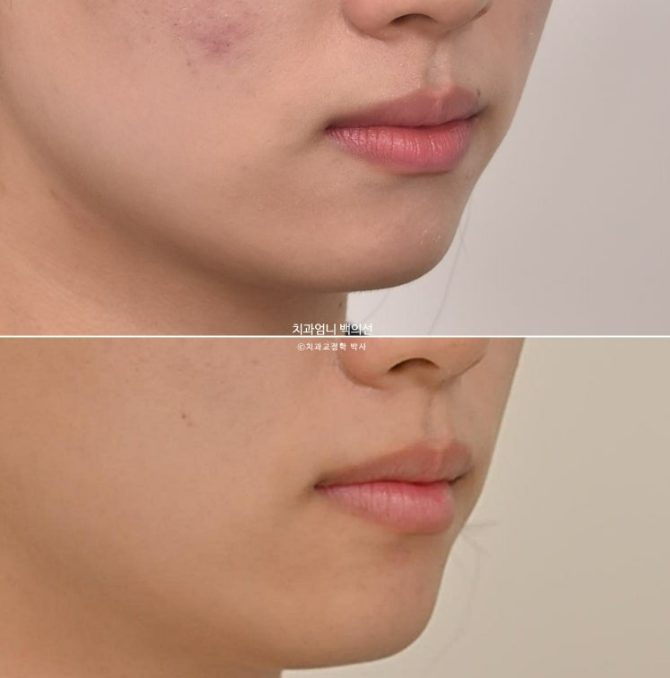 앞니 부분 교정 급속 교정 토끼이빨 MTA 미니튜브 치간삭제 치료기간 9개월 관련 이미지 19