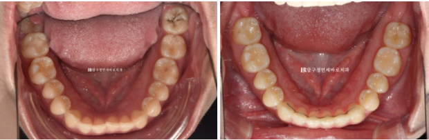 If Inward-Tilted Teeth Make Your Smile Look Constricted? Invisalign Before and After image 14