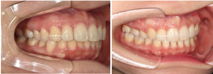 30대 돌출입 발치교정 입술부전증 치료 관련 이미지 14