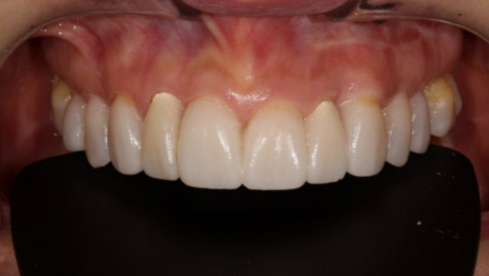 40대 오래된 크라운 교체 / 블랙트라이앵글 젤라미 치료 결과 관련 이미지 3
