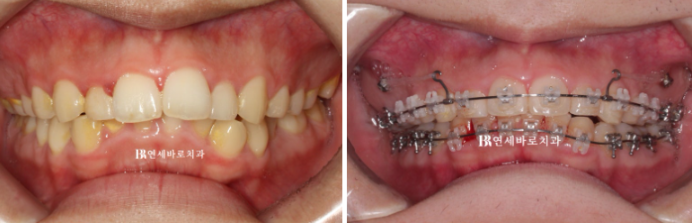 인비절라인 비추천 하는 경우? 관련 이미지 4