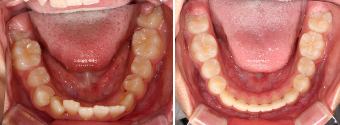 덧니 반대교합 과개교합 인비절라인 퍼스트 악궁확장 어린이 교정 관련 이미지 19