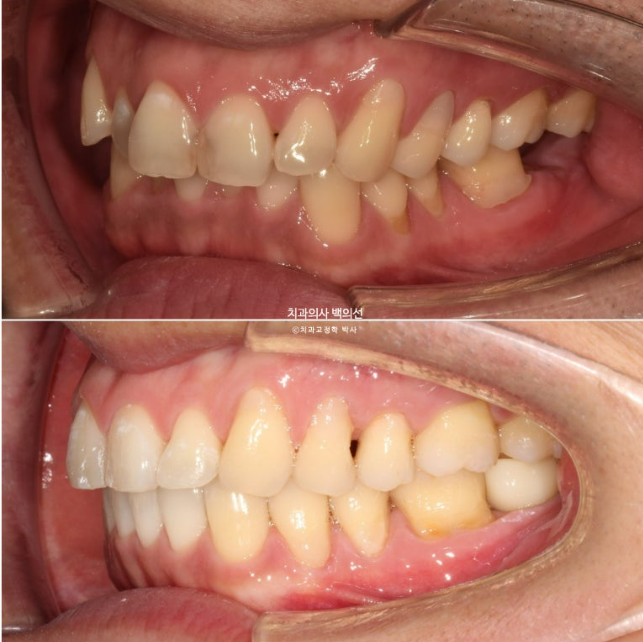 40대 인비절라인 라이트 과개교합 과잉치 덧니 교정 임플란트 보철 교정 후기 관련 이미지 21