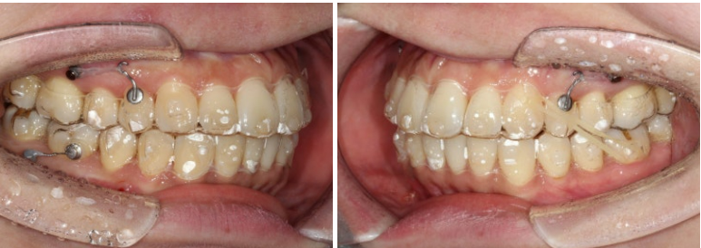 비발치 돌출입 인비절라인 교정 가위교합 중심선 맞추기 관련 이미지 13