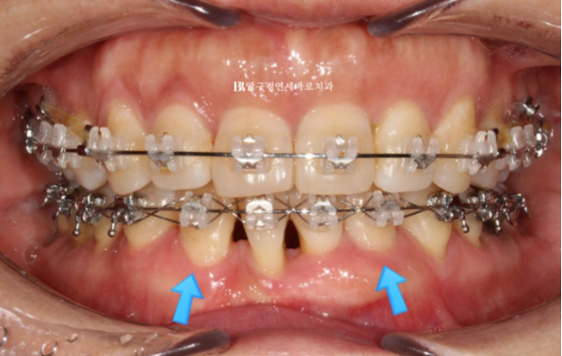40대 치아교정 가능할까요? 치주염 있어도 치아교정 가능할까요? 임플란트 없이 교정하기 관련 이미지 8