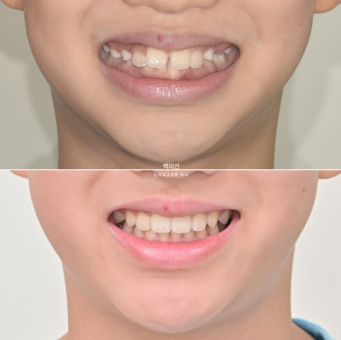 인비절라인퍼스트 어린이 투명교정 과개교합 덧니 악궁확장 돌출 관련 이미지 23