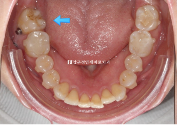 40대 인비절라인 라이트|가위교합도 10개월 만에 개선 가능할까요? 발치 없이 치료한 실제 증례 관련 이미지 10