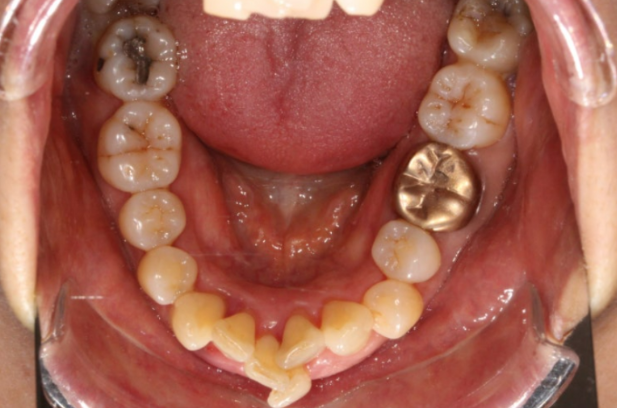 40대 치아교정 가능할까요? 치주염 있어도 치아교정 가능할까요? 임플란트 없이 교정하기 관련 이미지 2