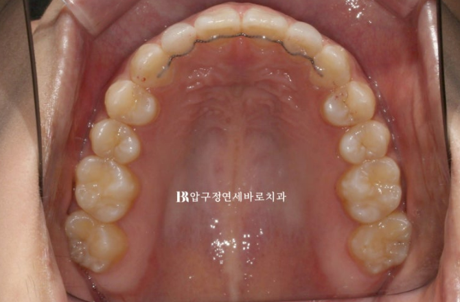 벌어진 앞니, 인비절라인과 무삭제 라미네이트로 자연스럽게 해결 관련 이미지 9