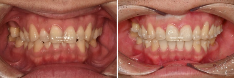 40대 인비절라인 라이트 과개교합 과잉치 덧니 교정 임플란트 보철 교정 후기 관련 이미지 11