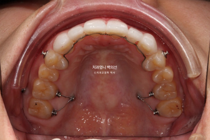 비수술 개방교합 클리피씨 30대 무삭제 라미네이트 치료기간 2년 관련 이미지 12