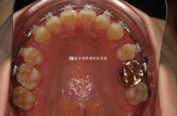 Gummy Smile Correction Review | Natural Improvement of Gummy Smile and Buccal Corridors Through Extraction Treatment for Protruding Teeth image 6