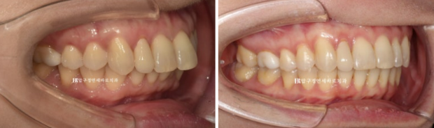 Can Invisalign Lite Work for Patients in Their 40s? A Real Case Improving Scissor Bite and Deep Bite in 10 Months image 14