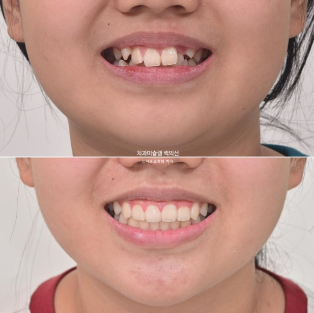 덧니 반대교합 과개교합 인비절라인 퍼스트 악궁확장 어린이 교정 관련 이미지 24