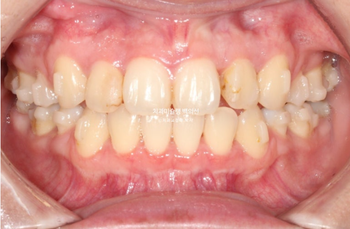 돌출입 인비절라인 발치교정 거미스마일 잇몸미소 잇몸돌출 입술부전증 무턱 재교정 관련 이미지 10
