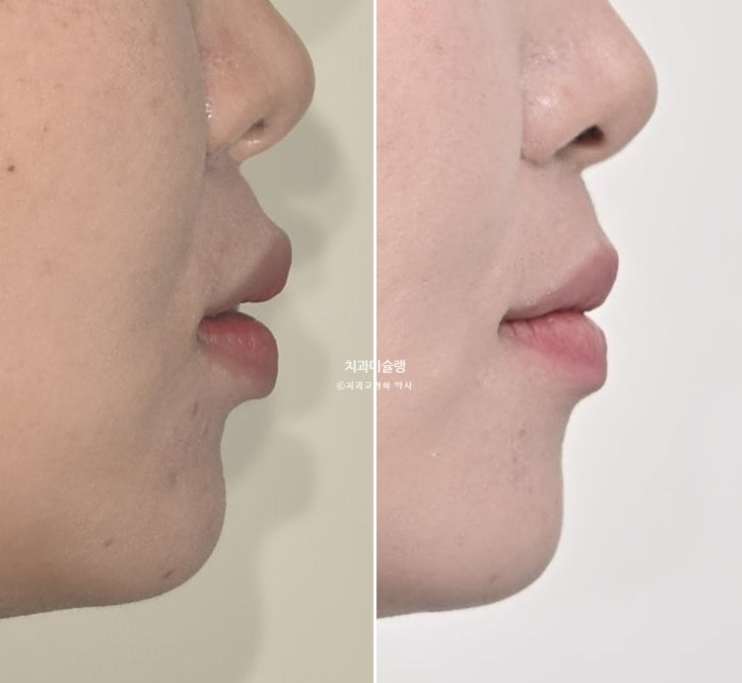 비발치 돌출입 인비절라인 교정 가위교합 중심선 맞추기 관련 이미지 26