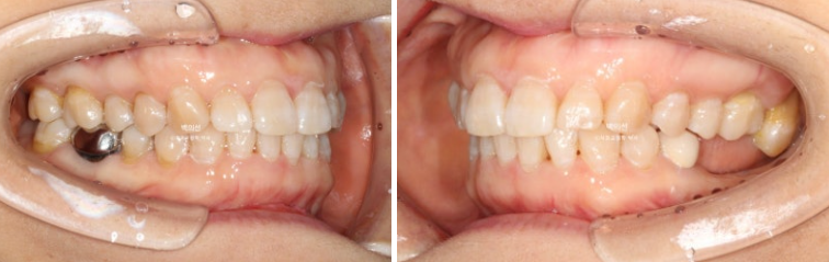 40대 인비절라인 라이트 앞니 돌출 과개교합 덧니 교정 후기 관련 이미지 13
