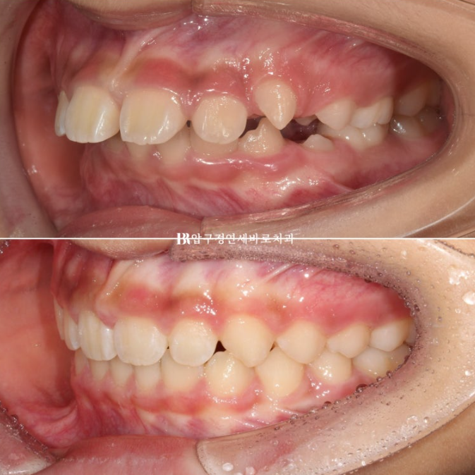 Pediatric Clear Aligners That Improved Both Deep Bite and Protruding Teeth image 16