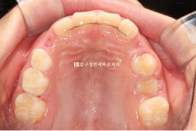 무턱교정 어린이 투명교정 인비절라인 퍼스트 교정 후기 관련 이미지 18