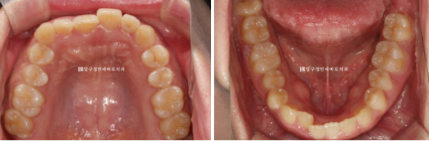 앞니부분교정 기간? MTA 미니튜브 교정 반대교합 교정 관련 이미지 3