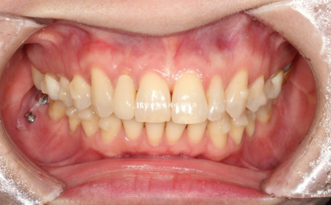 Invisalign Lite for Orthodontic Treatment in Your 40s: Crossbite and Protrusive Mouth Correction image 9
