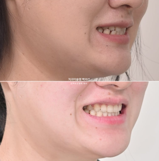 앞니 벌어짐 합죽이 방지 교정 기간 1년 4개월 관련 이미지 16