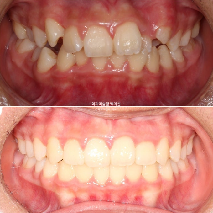 덧니 반대교합 과개교합 인비절라인 퍼스트 악궁확장 어린이 교정 치료 관련 이미지 22
