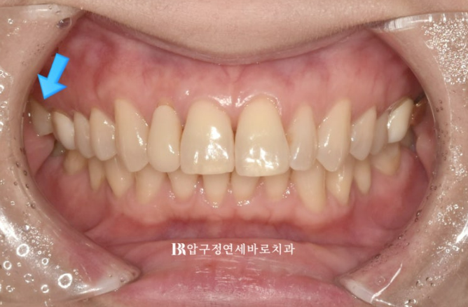 Invisalign Lite for Orthodontic Treatment in Your 40s: Crossbite and Protrusive Mouth Correction image 3