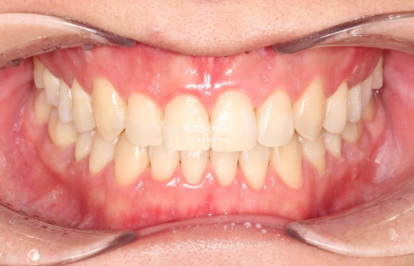 MSE Palatal Expansion Invisalign Underbite Correction, Non-Surgical image 14