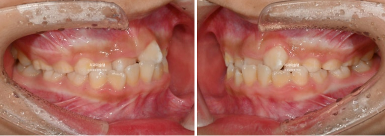 7세 어린이 반대교합 부정교합 프리올소 치료 관련 이미지 3