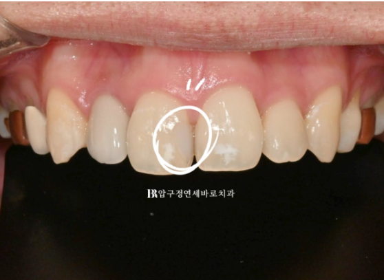 압구정 반점치 치료｜앞니 흰 반점(반상치) 앞니에 하얀얼룩? 관련 이미지 6