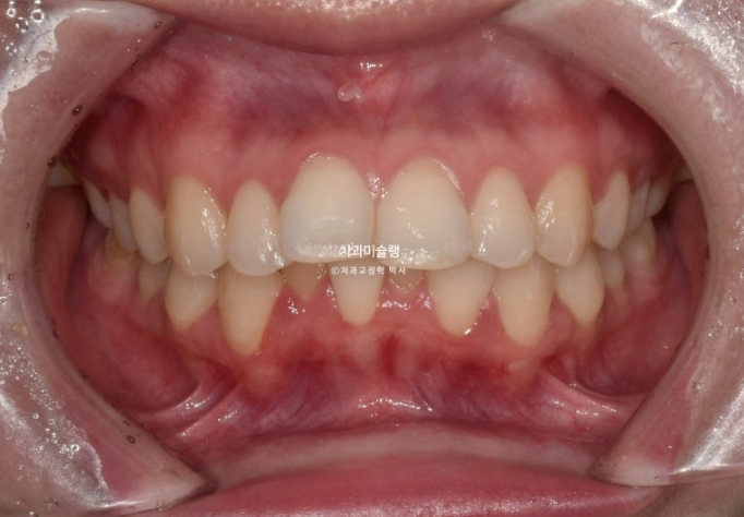 심한 돌출입 입술부전증 호두주름 발치교정 치료 관련 이미지 2
