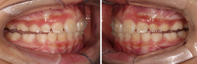 Invisalign First Correction for a Retruded Chin in a Child Orthodontic Treatment for Protrusion image 12