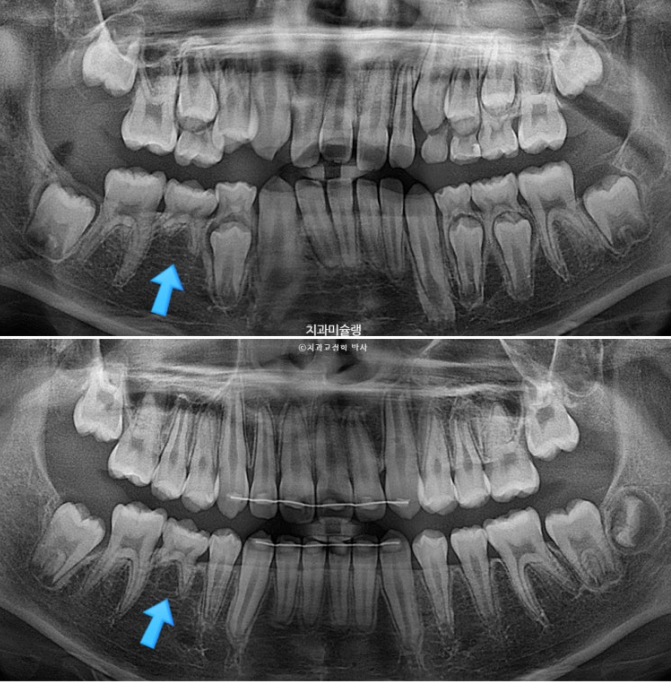 선천적 결손 잔존유치 과개교합 돌출입 인비절라인 퍼스트 어린이 투명교정 치료기간 관련 이미지 27