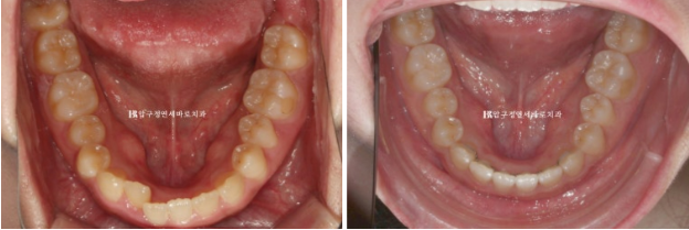 앞니부분교정 기간? MTA 미니튜브 교정 반대교합 교정 관련 이미지 7