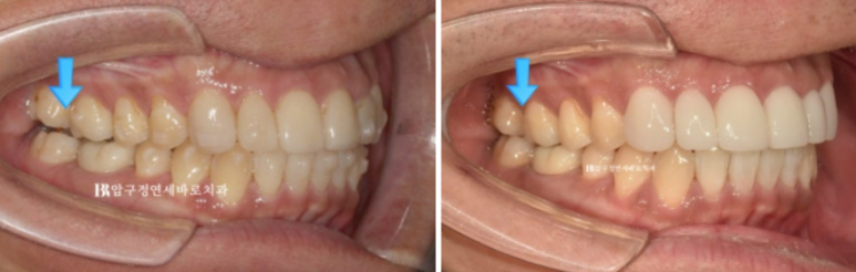 40대 중년 치아교정 인비절라인 라이트 치료기간 8개월 관련 이미지 9