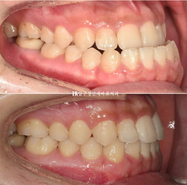 양악수술 교정 인비절라인 주걱턱 교정 치료 후기 관련 이미지 1