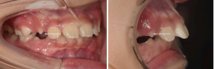 Pediatric Clear Aligners That Improved Both Deep Bite and Protruding Teeth image 2