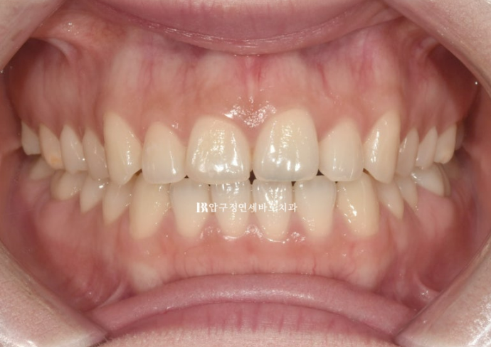 스마일라인 개선 무삭제 라미네이트 실제 두께 ? 관련 이미지 1