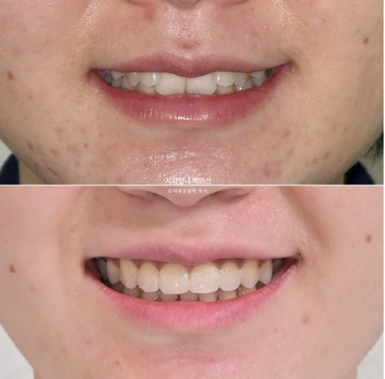 Inward-Tilted Teeth Orthodontic Treatment Review | A Real Case of Treating Congenitally Missing Lower Incisor (Three Lower Front Teeth) Without Extractions image 14