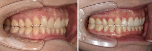 If Inward-Tilted Teeth Make Your Smile Look Constricted? Invisalign Before and After image 11