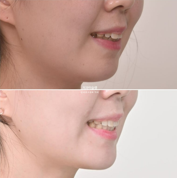 비발치 인비절라인 교정 편측 개방교합 가위교합 돌출 재교정 관련 이미지 24