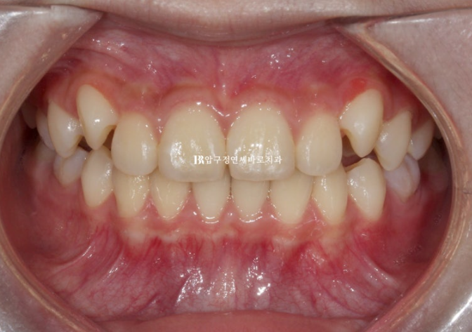 어린이교정 투명교정 인비절라인 퍼스트 후기 관련 이미지 6