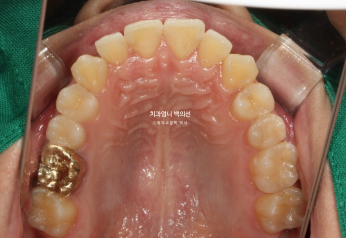 인비절라인 비발치 앞니 돌출 덧니 교정 ? 관련 이미지 4