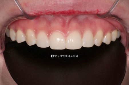 왜소치·원추형 치아, 교정 대신 무삭제 라미네이트로 개선한 사례 관련 이미지 7