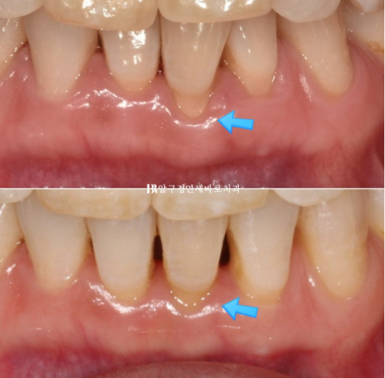 50대 중년교정 인비절라인 라이트 나비치아 교정 앞니 교정 후기 관련 이미지 14