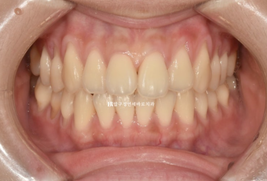 인비절라인 익스프레스 토끼이빨 교정 기간? 인비절라인 종류는? 관련 이미지 2