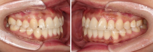 Invisalign Success Depends on Wearing Them Consistently|9-Month Real Treatment Case of Crowding & Underbite image 11